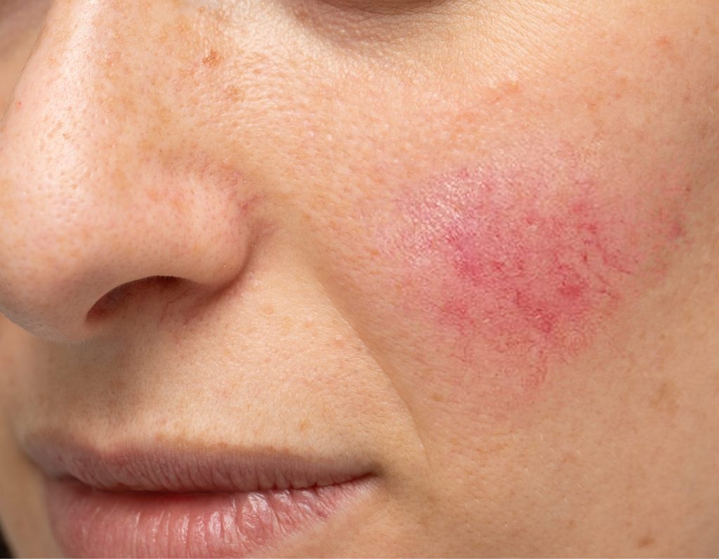 How Can Facial Capillary Treatment Deliver Clear Skin?