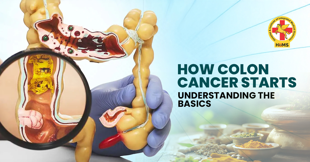 What is Colon Cancer? Causes, Early Development, and Risk Factors Explained Simply