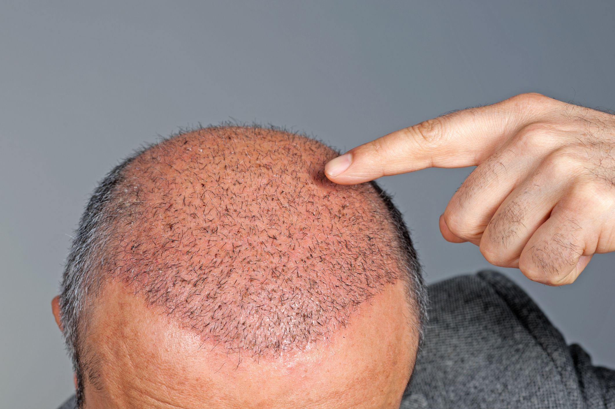 How Do Hair Transplant Outcomes Enhance Hair Appearance?