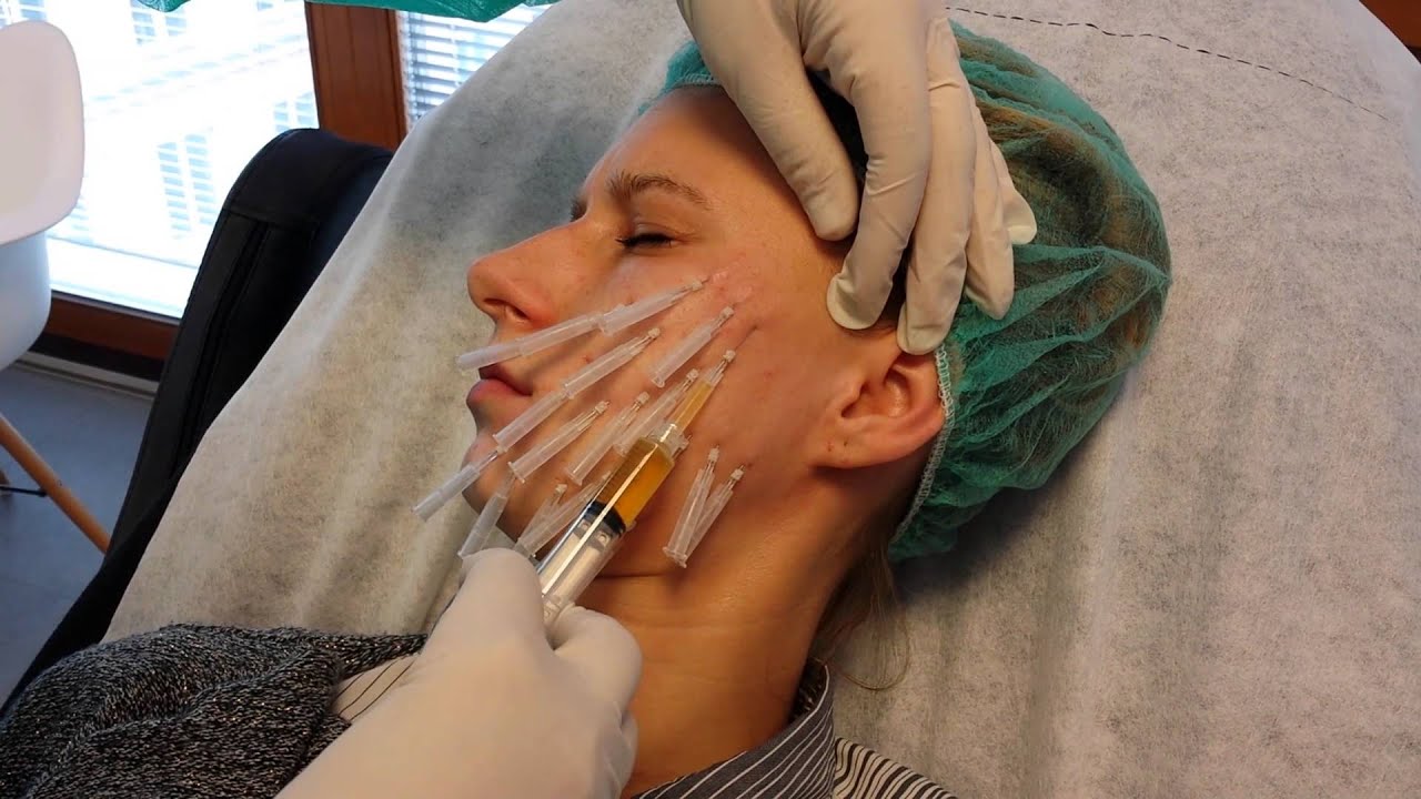 How Do PDO Mono Threads Improve Collagen Levels in Skin?