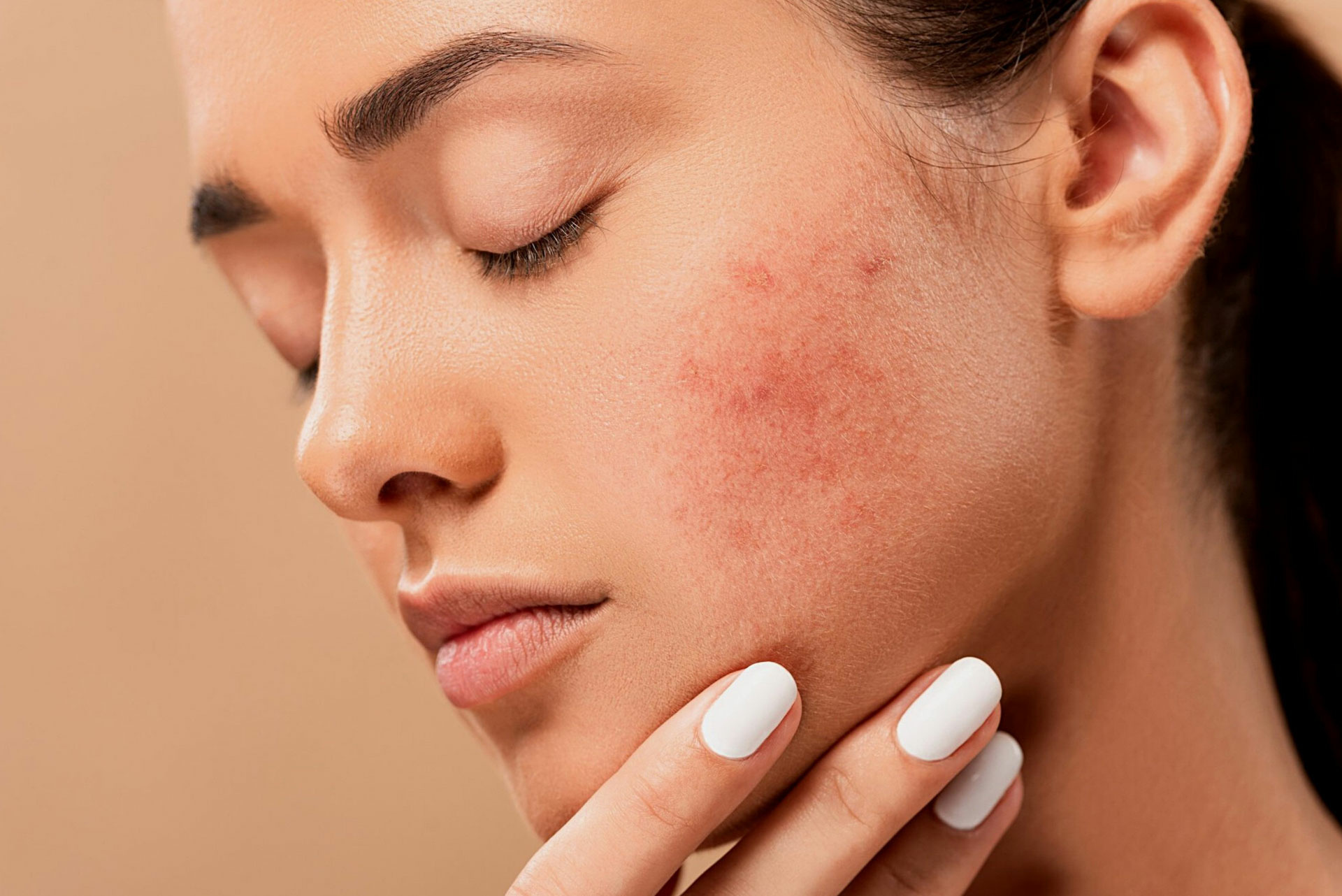 How Does Best Acne Treatment Improve Long-Term Skin Health?