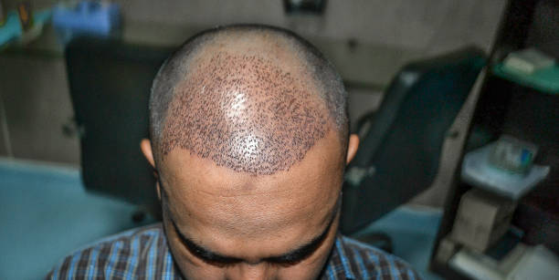How Does Hair Transplant Improve Hairline Shape Naturally