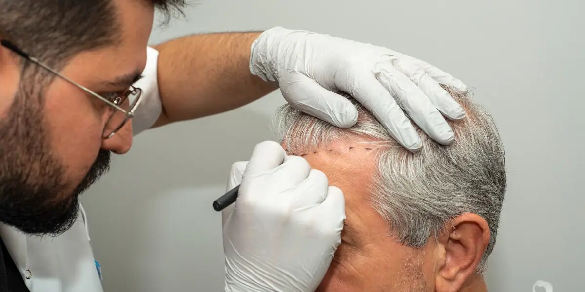 How Does Hair Transplant Use Natural Hair Follicles?