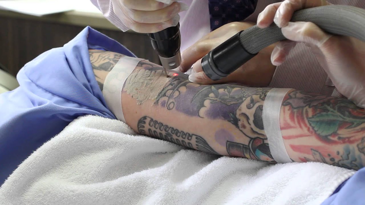 How Does Laser Tattoo Removal Fade Dark Tattoos?