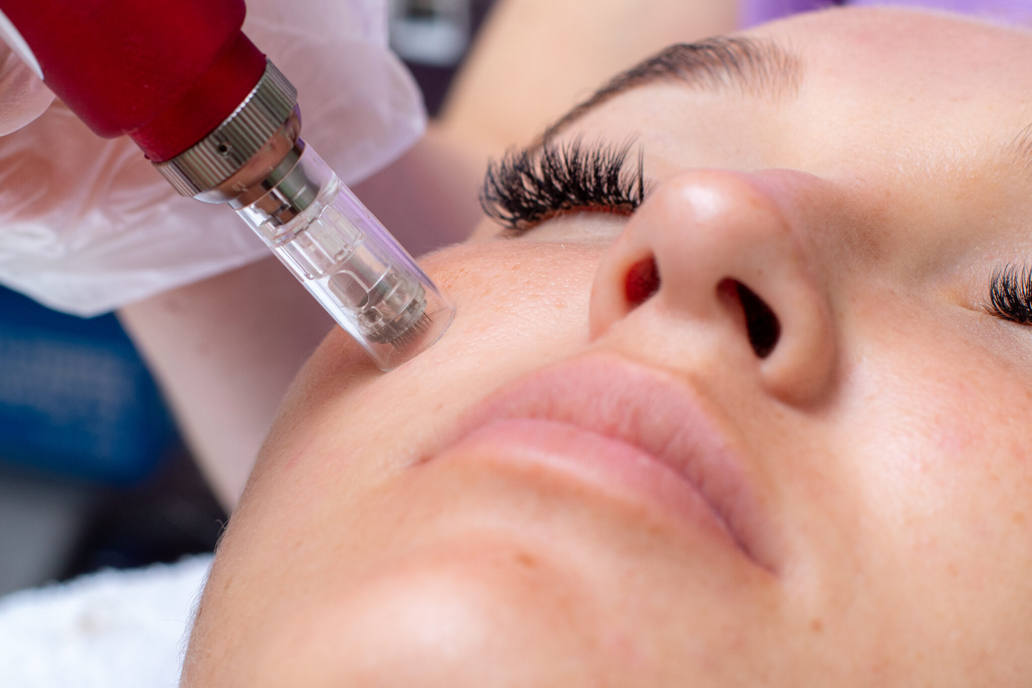 How Does Microneedling Stimulate Collagen Production?