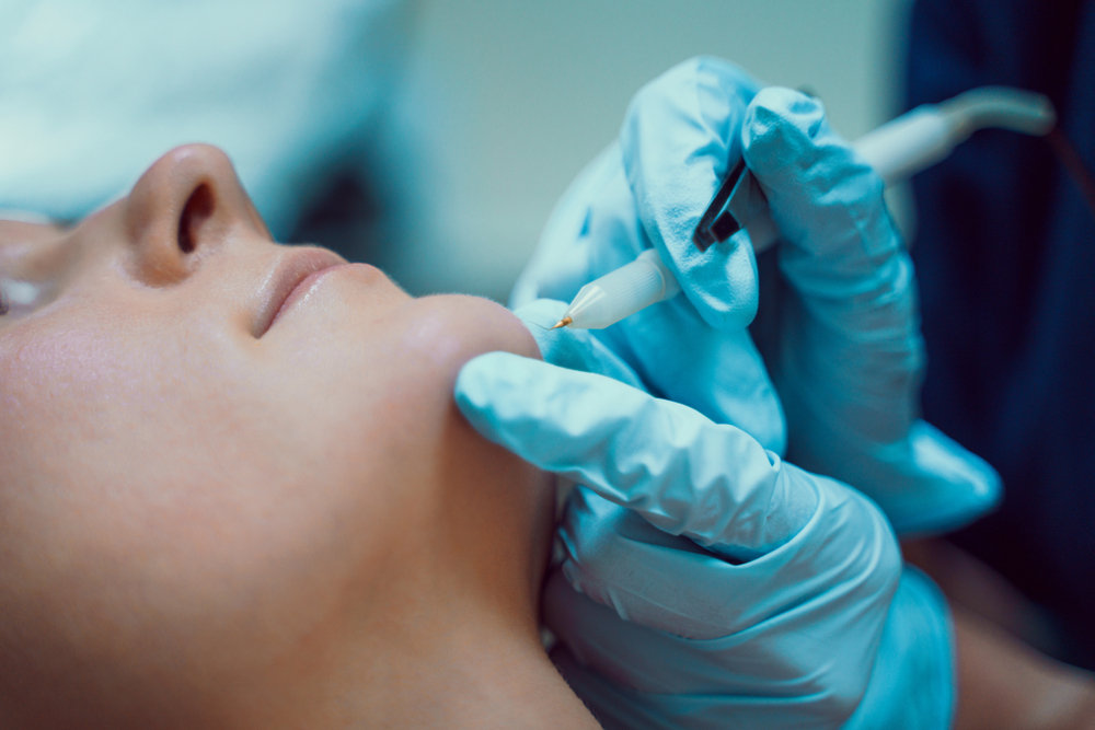 How Electrolysis Laser Hair Removal in Abu Dhabi Feels