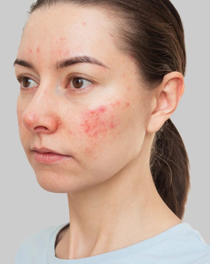 How Safe Is Actinic Keratosis treatment in Abu Dhabi Today?