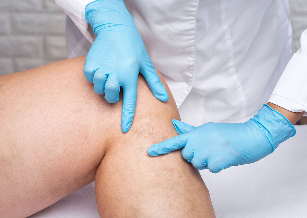 How Sclerotherapy in Abu Dhabi Works for Visible Veins