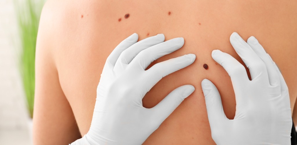 How Skin Tag Removal Treats Visible Skin Lumps and Bumps?