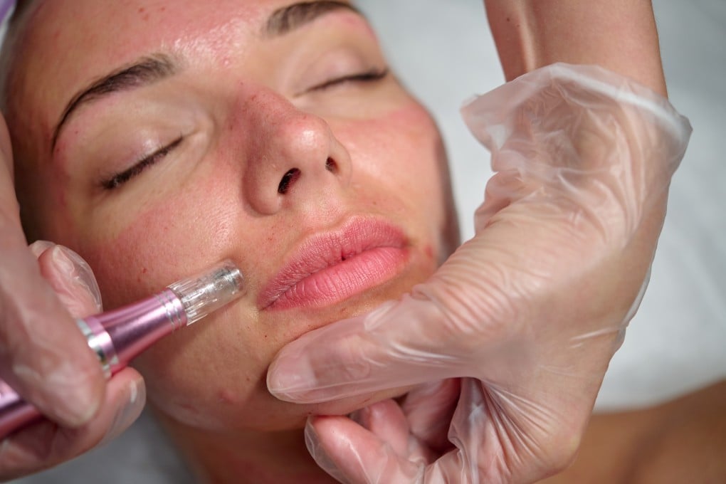 How Soon Do Dermapen Microneedling Results Show?