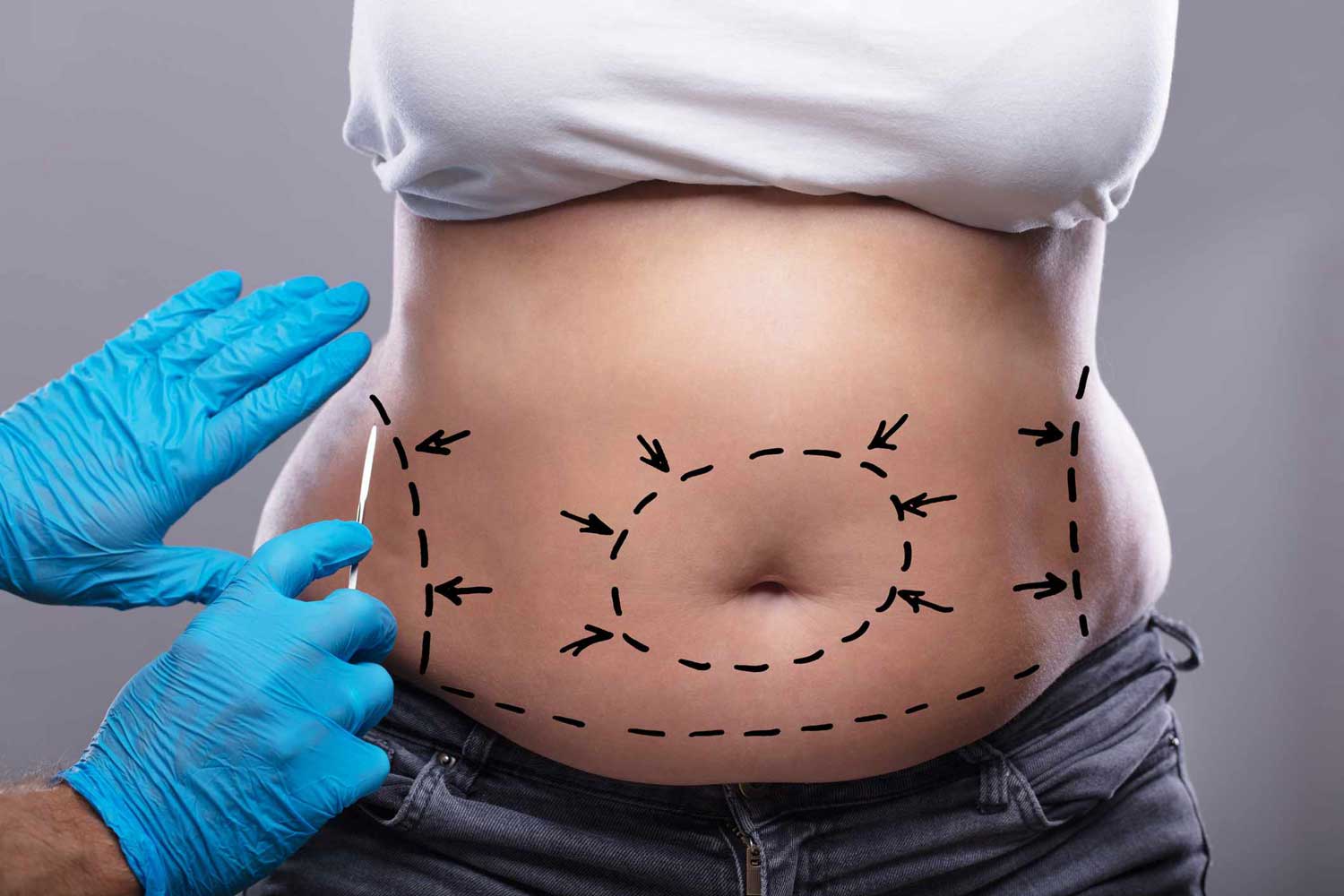 How Tummy Tuck in Abu Dhabi Improves Body Confidence Fast