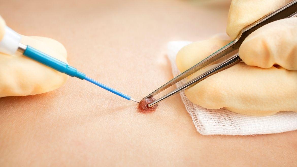 How Warts Removal Treatment in Abu Dhabi Removes Growths