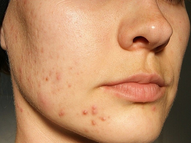Is Acne Treatment Right For Stubborn Chin And Jawline Acne