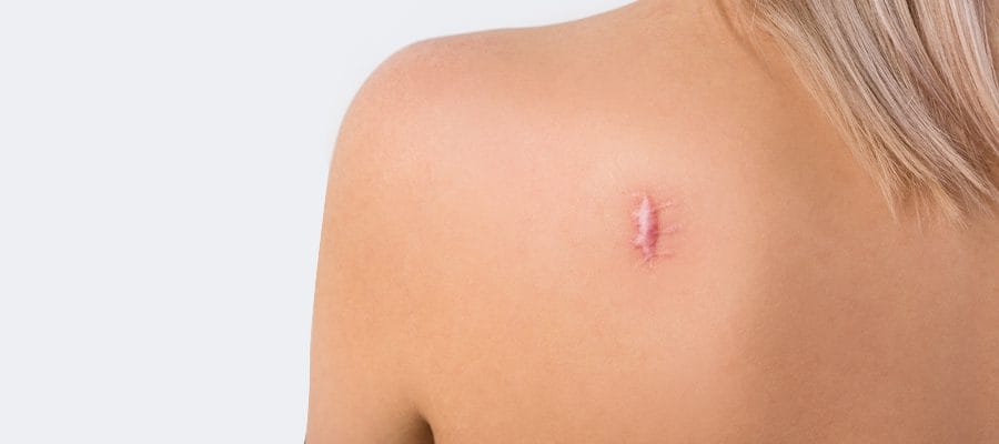 Is Keloid Treatment in Abu Dhabi Worth Trying Today