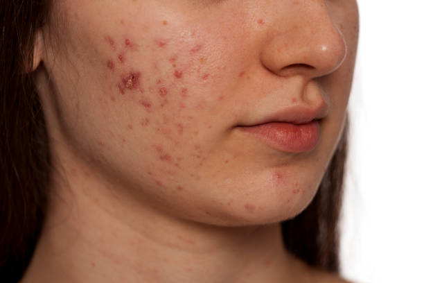 Is Laser Acne Scar treatment Safe For Sensitive Skin Types