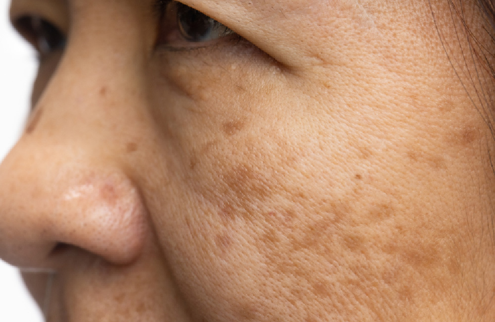 Is Pigmentation Treatment in Abu Dhabi Worth Trying Today