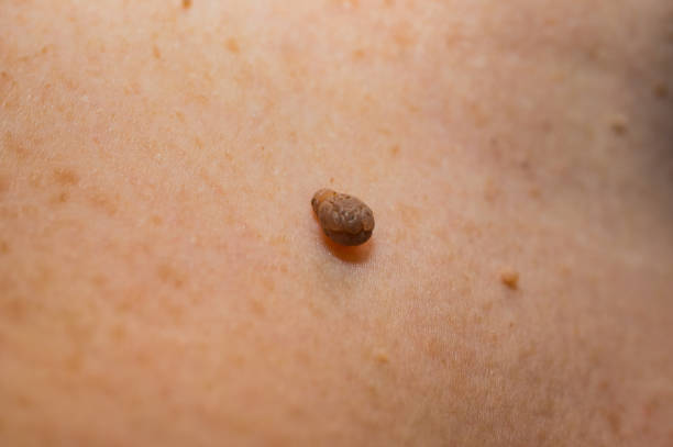 Is Wart Removal Worth It for Long Lasting Skin Results