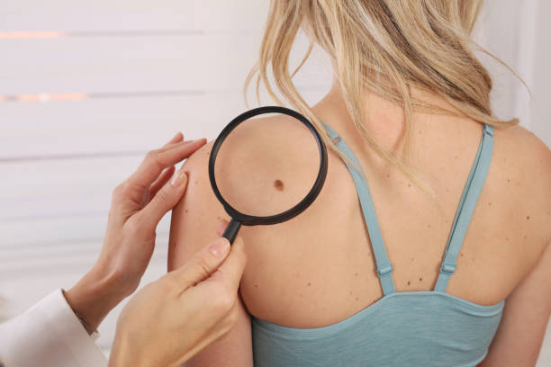 Is Wart Removal the Right Choice for Chronic Warts?