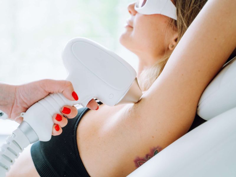 What Are the Benefits of Laser Hair Removal in Surrey BC?