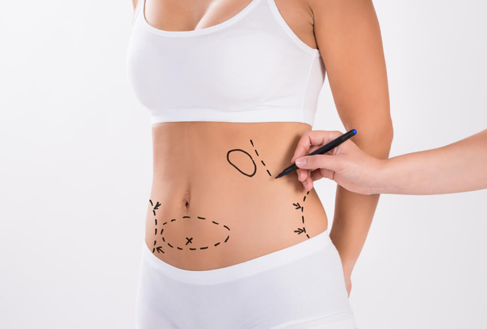 How Expensive Is Liposuction Compared to Other Procedures?