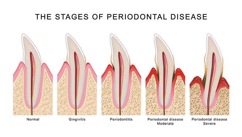 Bridge Specialist Endicott: Restoring Smiles with Precision and Care