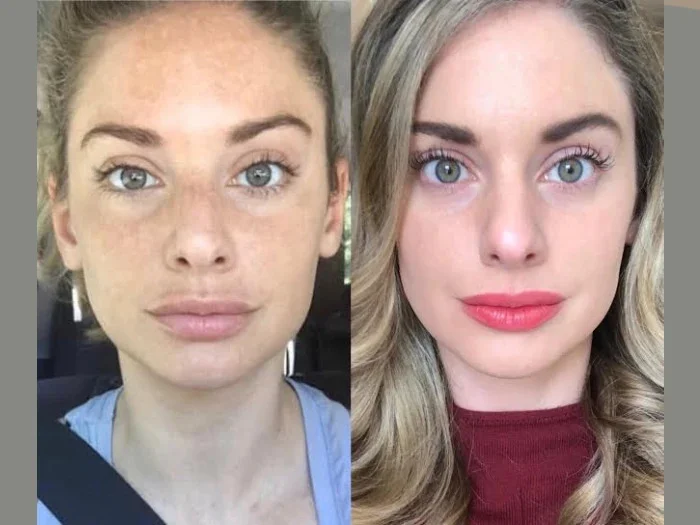 Radiofrequency (RF) Microneedling in Dubai Refined Facial Texture