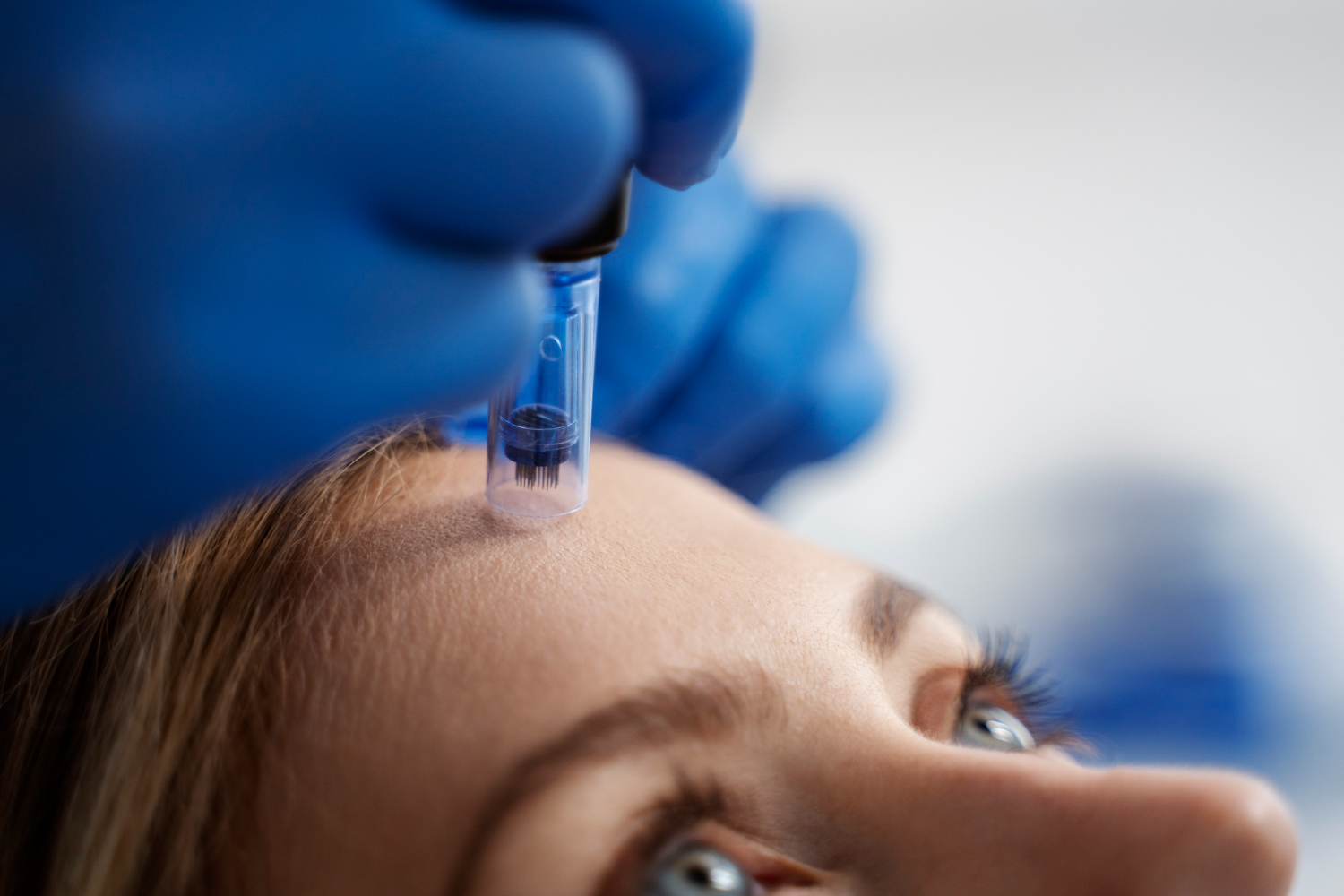 Skinpen Microneedling in Altrincham: Real Patient Experiences and Results