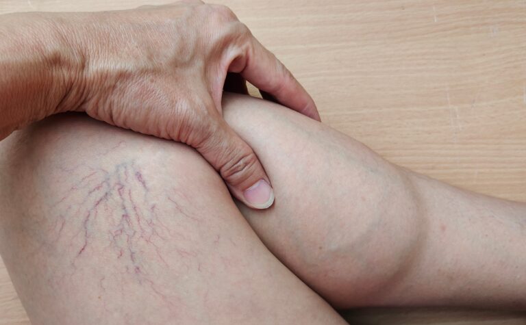 Spider Veins Treatment for Facial Veins: What to Expect