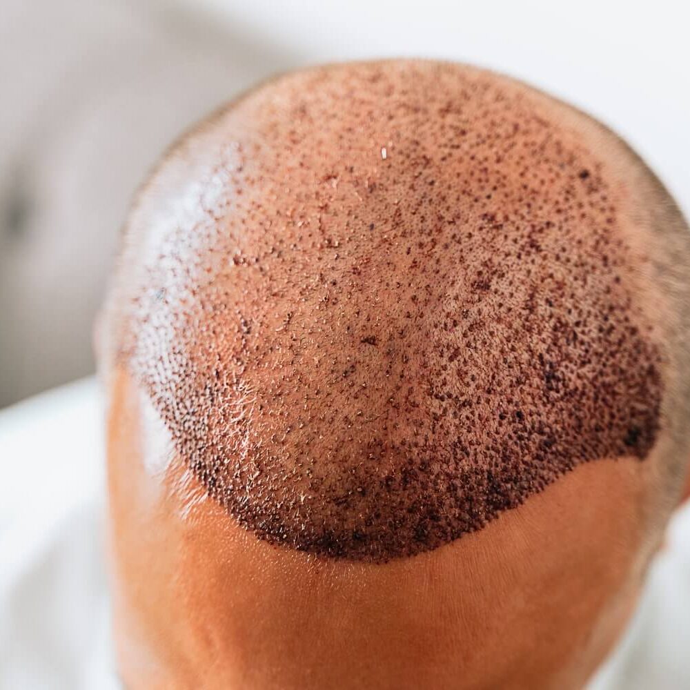 Hair Transplant Is It Really Worth It in 2026