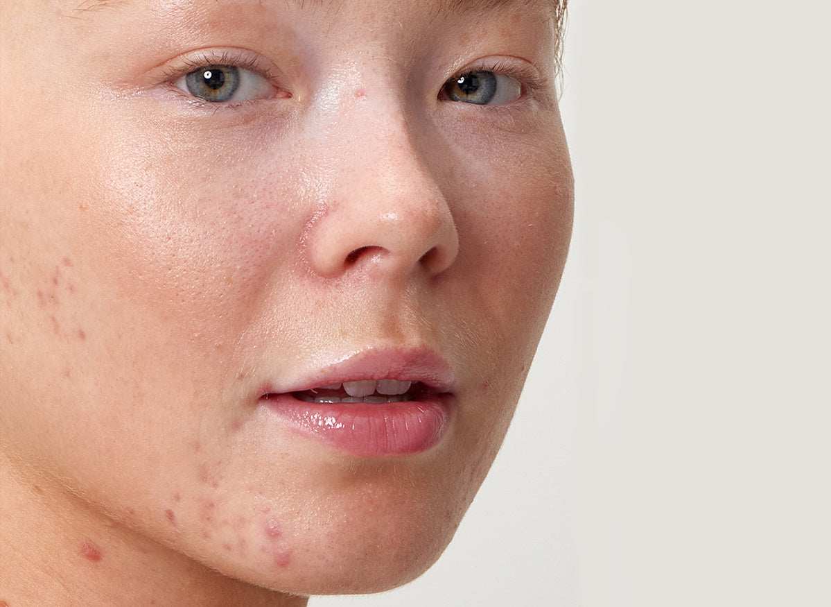 What Acne Treatment Abu Dhabi Clears Breakouts Fast