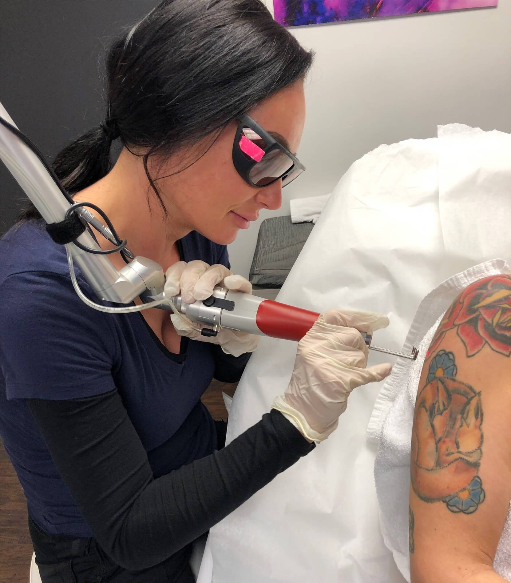 What Benefits Make Laser Tattoo Removal Widely Preferred?