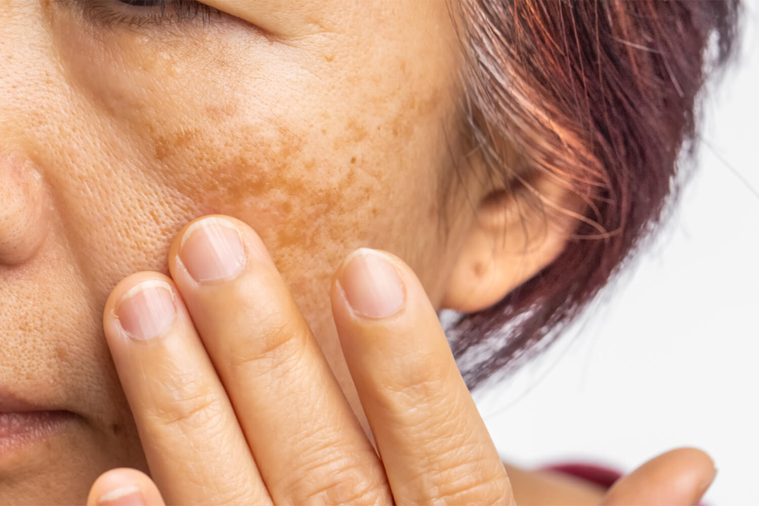 What Makes Melasma Treatment in Abu Dhabi So Effective