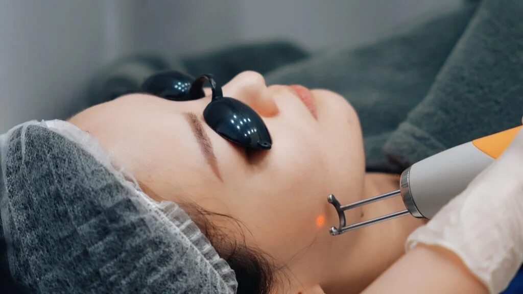 What Should You Expect After Pico Laser for Face Pigmentation?