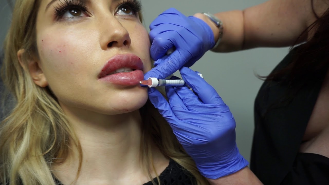 What Should You Expect After a Lip Lift Procedure Treatment?