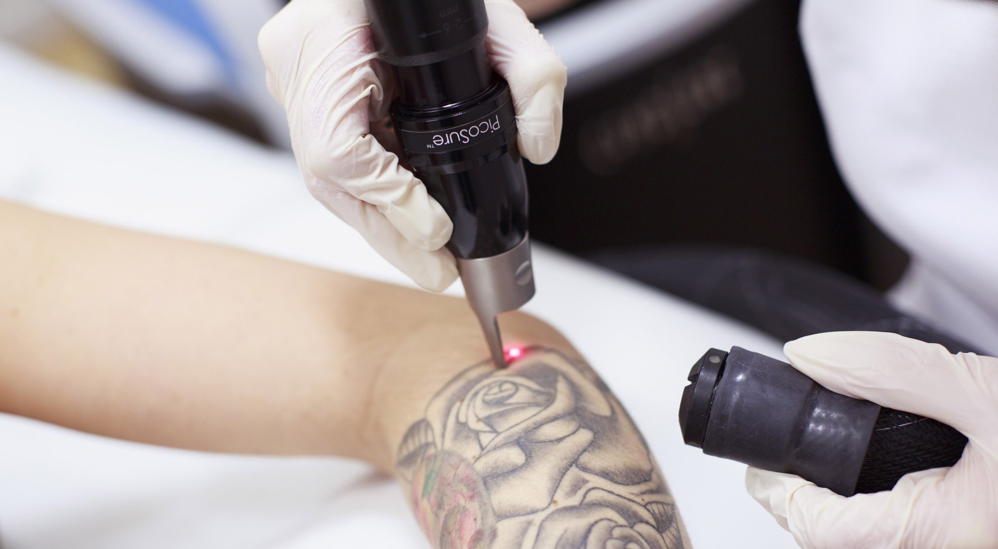 What to Expect From Picosure Tattoo Removal in Abu Dhabi