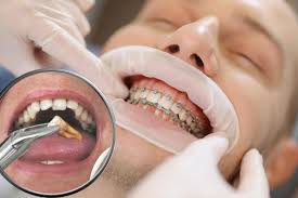 Dental Implants vs Dentures: Which Wins for Long-Term UK Smiles?