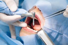 Private Teeth Removal: Safe, Fast & Stress-Free Care