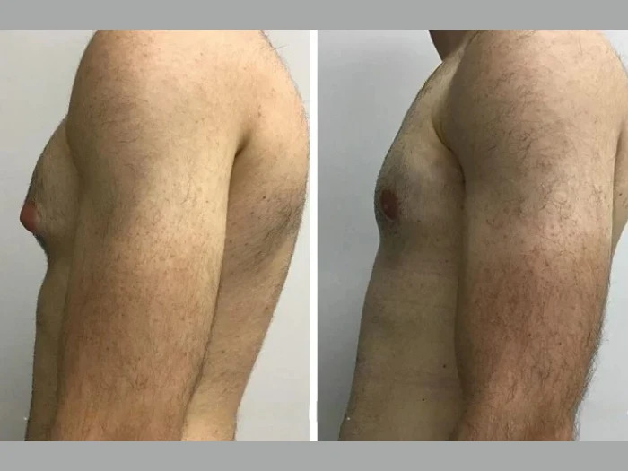 How Modern Clinics Ensure Patient Safety with Gynecomastia surgery in Dubai