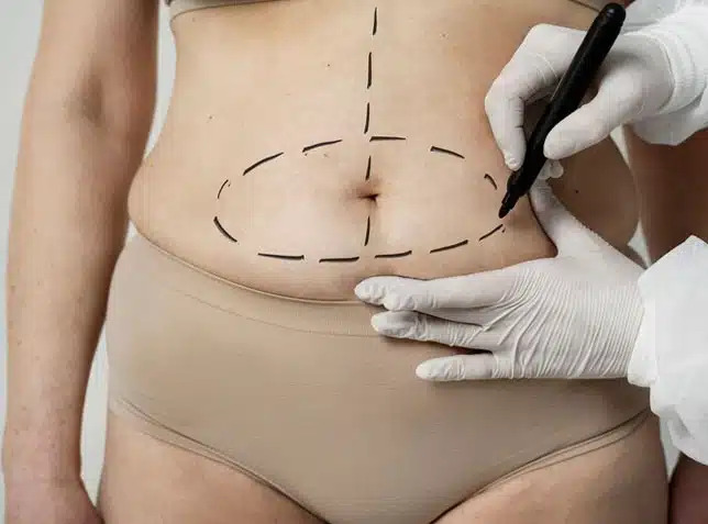 Can You Combine Liposuction With Tummy Tuck in Dubai?