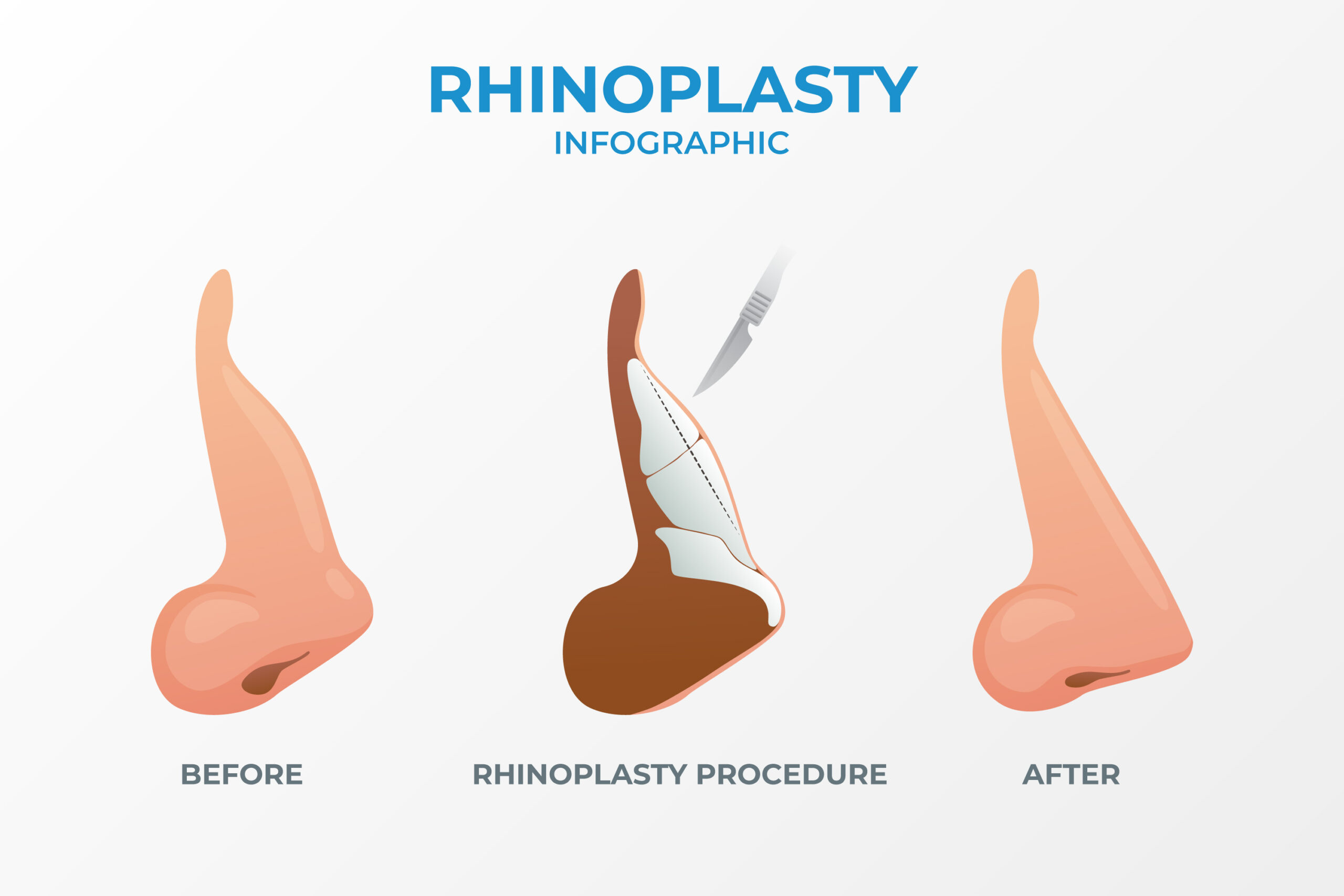 Rhinoplasty 101: Everything You Need to Know Before Your Nose Job