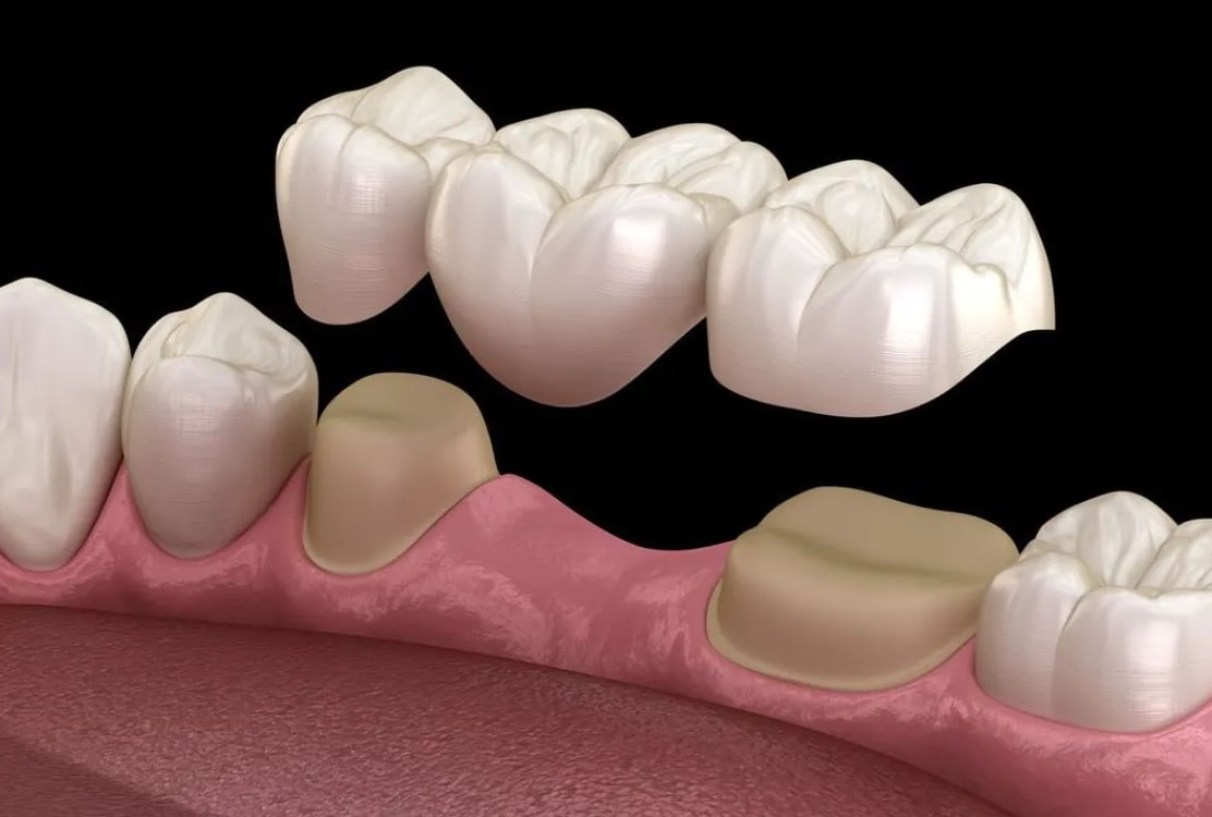 Adult Orthodontic Treatment in Bikaner: It’s Never Too Late for a Perfect Smile