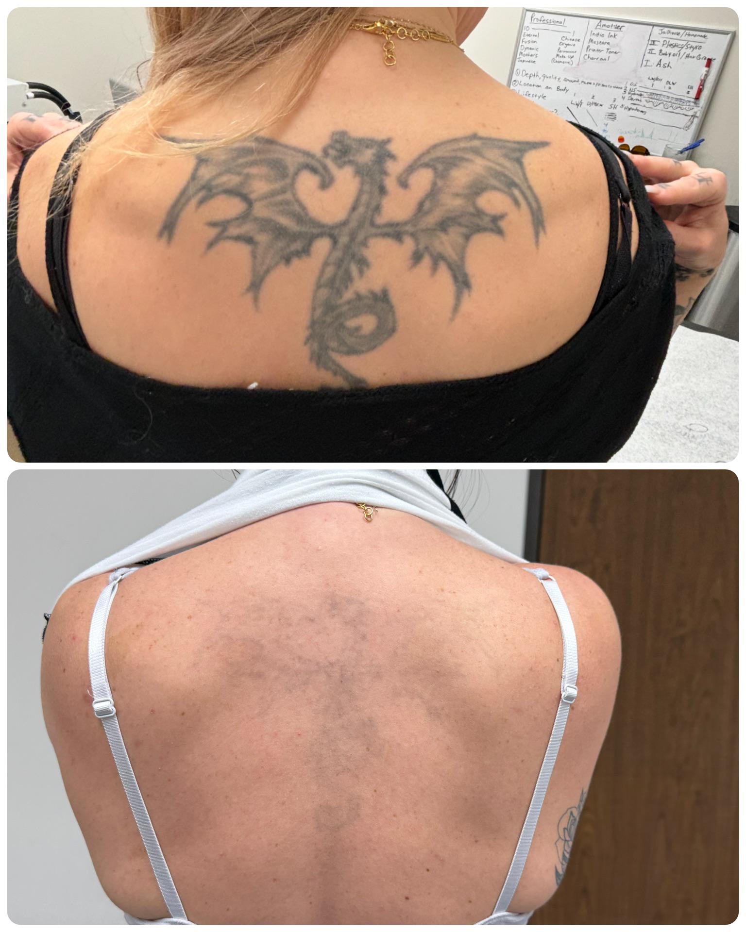 Bold Skin Freedom Picosure Tattoo Removal smooth radiant skin look