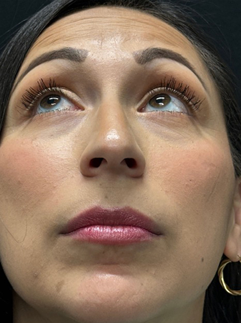 Achieve Natural-Looking Results Through Rhinoplasty