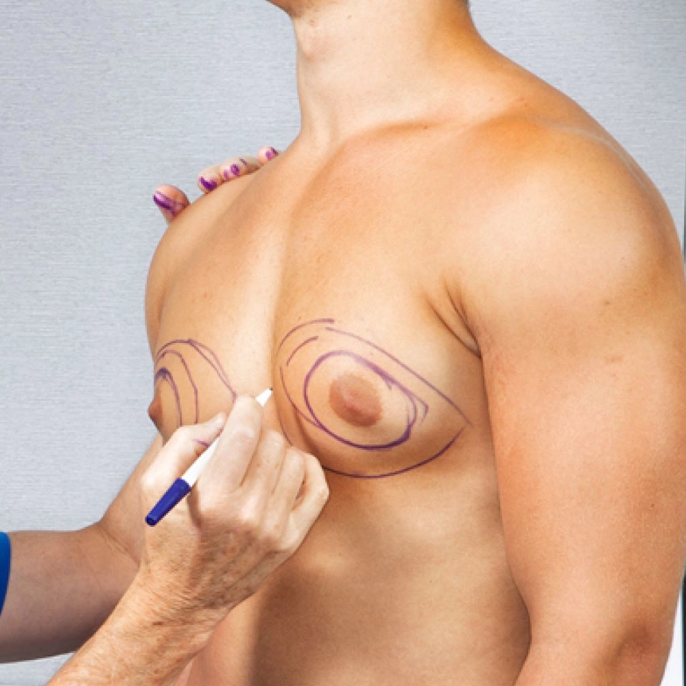 Achieve a More Contoured Chest with Gynecomastia Surgery