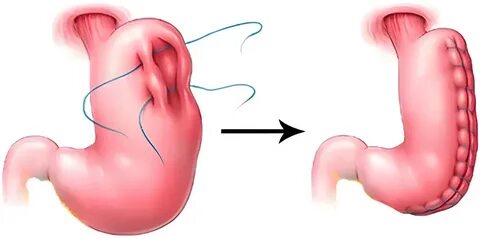 Can Gastric Plication Help Long-Term Weight Control?