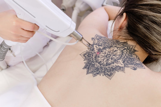 Can Laser Tattoo Removal Treat Large and Small Tattoos?