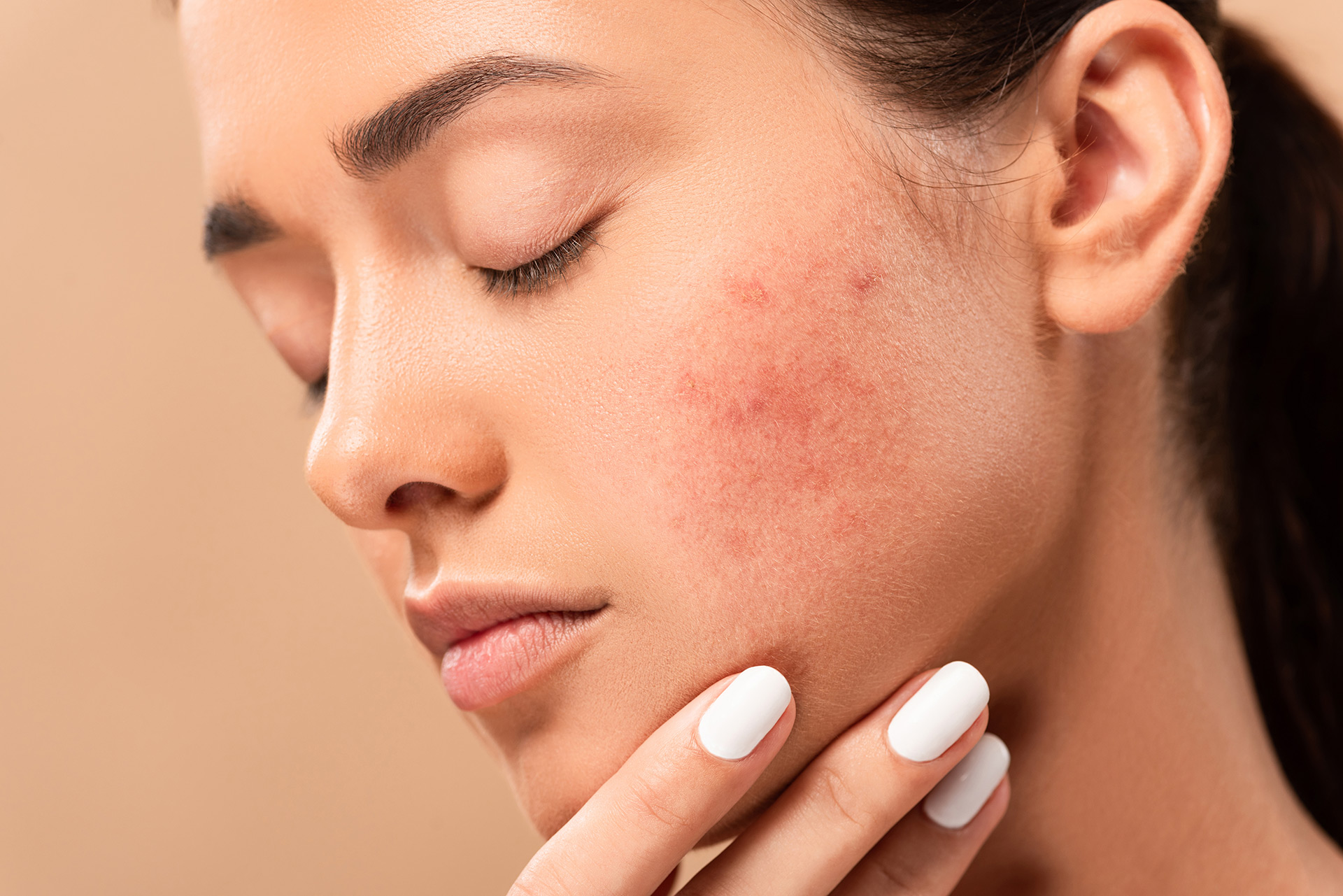 Can Pimples Be Controlled Through the Hydration?