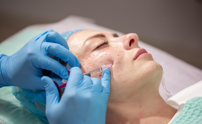 Can a Vampire Facial smooth rough skin texture?