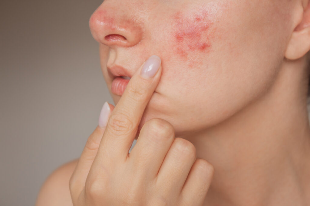 Can pimples treatment help achieve spotless glowing skin?