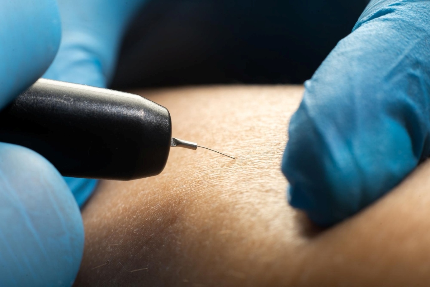 Does Electrolysis Laser Hair Removal Abu Dhabi Suit All Skin?